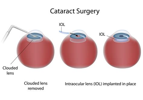 cataract surgery in huddersfield